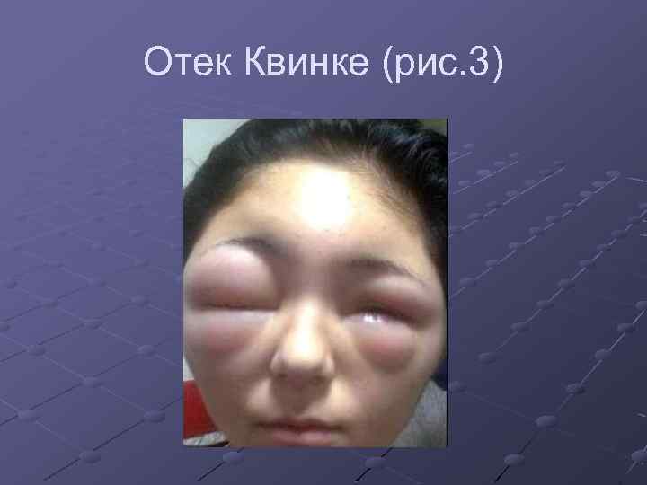 Отек Квинке (рис. 3) 