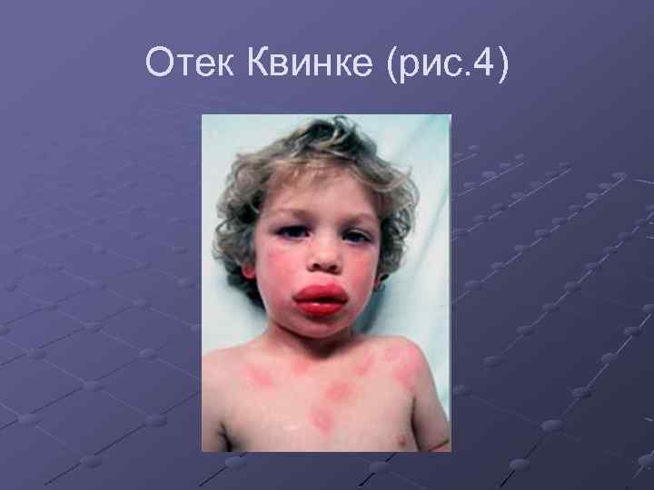 Отек Квинке (рис. 4) 