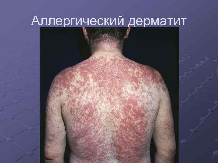 Аллергический дерматит 