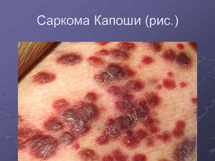 Саркома Капоши (рис. ) 
