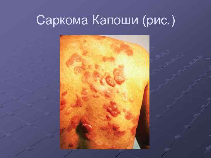 Саркома Капоши (рис. ) 