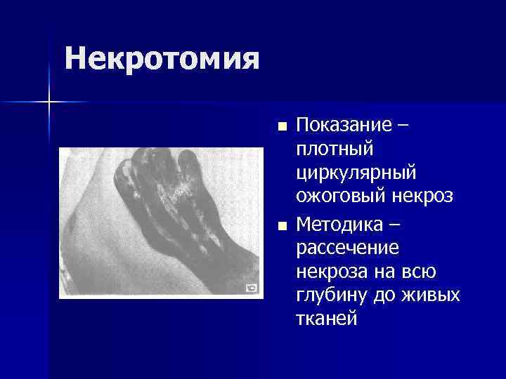 Некротомия n n Показание – плотный циркулярный ожоговый некроз Методика – рассечение некроза на