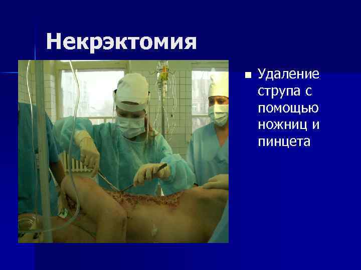 Некрэктомия n Удаление струпа с помощью ножниц и пинцета 