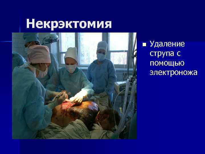 Некрэктомия n Удаление струпа с помощью электроножа 