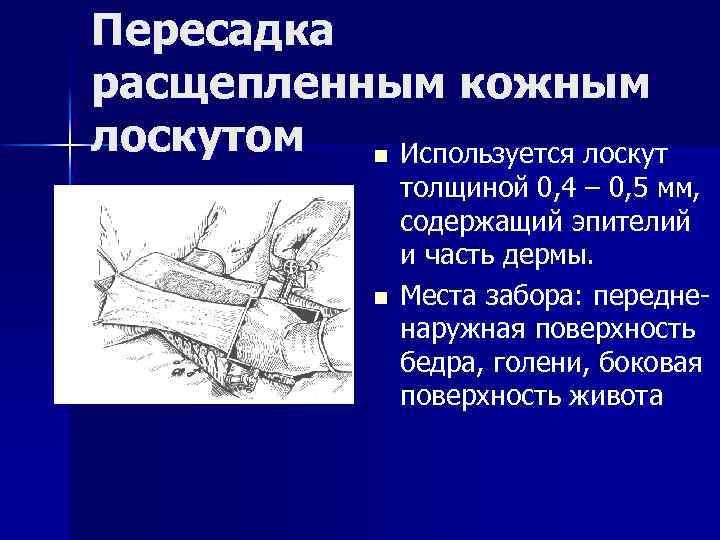 Пересадка расщепленным кожным лоскутом n Используется лоскут n толщиной 0, 4 – 0, 5