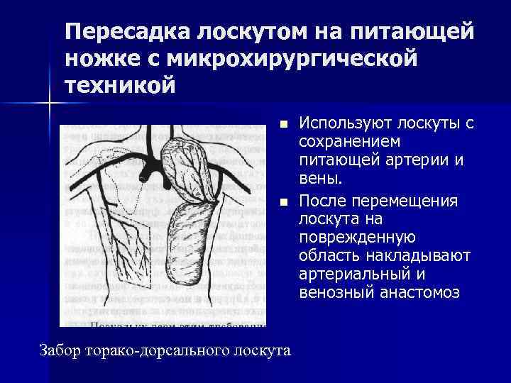 Лоскут используют. Торакодорсальный лоскут. Пластика лоскутом на сосудистой ножке с микрохирургической техникой. Пластика лоскутом на сосудистой ножке. Перемещение кожного лоскута на ножке.