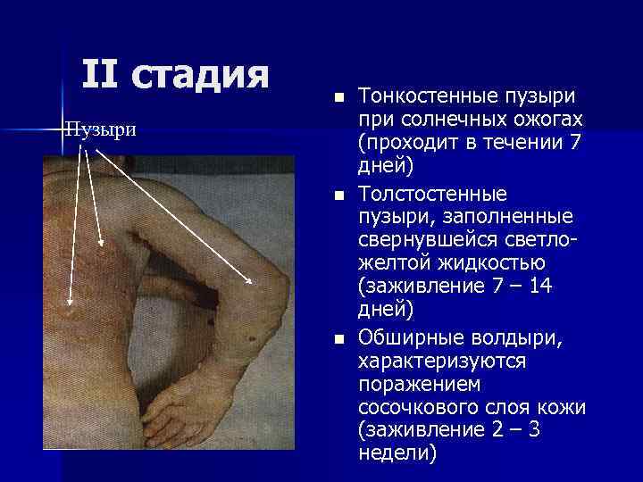 II стадия n Пузыри n n Тонкостенные пузыри при солнечных ожогах (проходит в течении