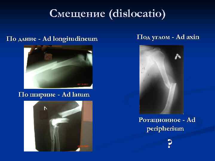 Смещение (dislocatio) По длине - Ad longitudineum Под углом - Ad axin По ширине