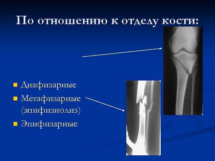 Карта вызова закрытый перелом большеберцовой кости