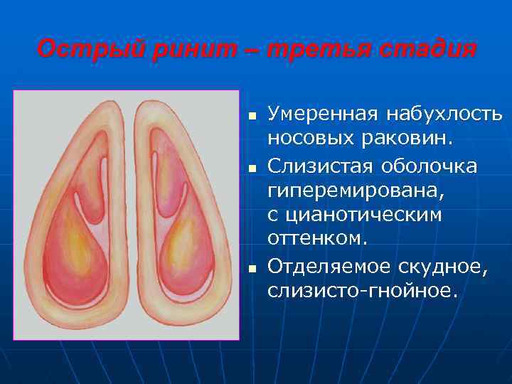 Острый ринит – третья стадия n n n Умеренная набухлость носовых раковин. Слизистая оболочка