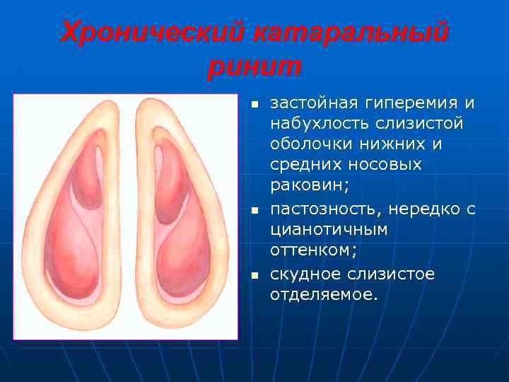 Хронический катаральный ринит n n n застойная гиперемия и набухлость слизистой оболочки нижних и