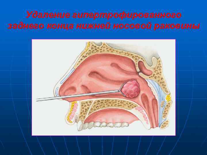 Удаление гипертрофированного заднего конца нижней носовой раковины 