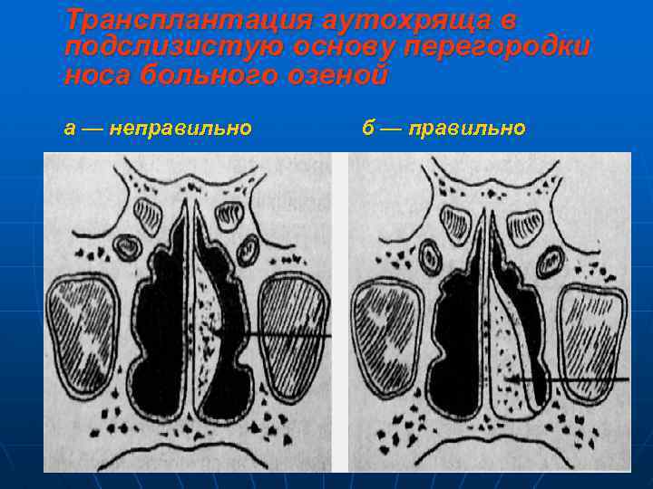 Трансплантация аутохряща в подслизистую основу перегородки носа больного озеной а — неправильно б —