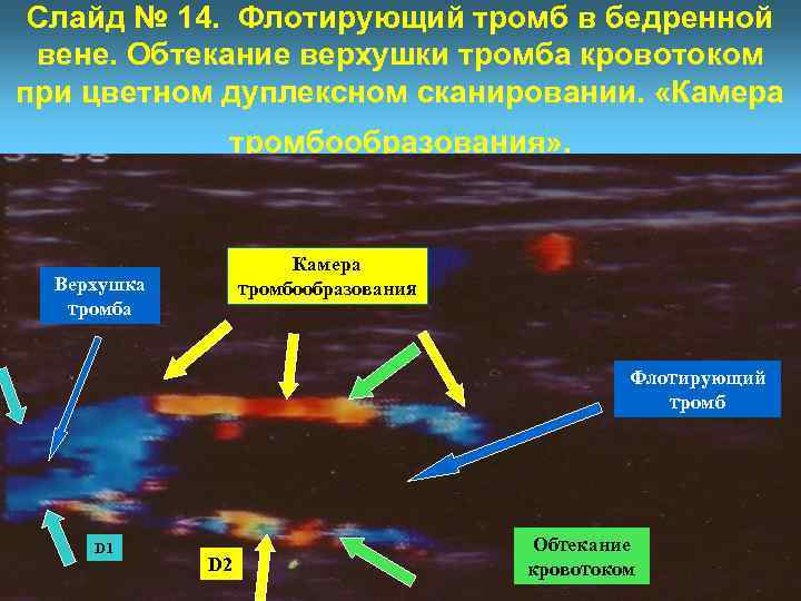 Слайд № 14. Флотирующий тромб в бедренной вене. Обтекание верхушки тромба кровотоком при цветном