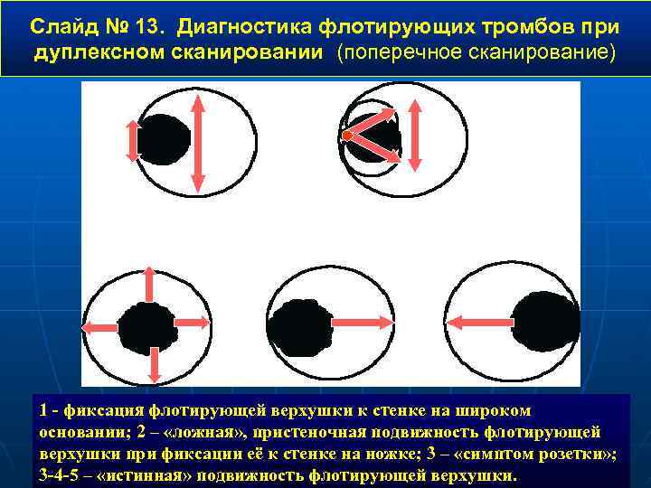 Слайд № 13. Диагностика флотирующих тромбов при дуплексном сканировании (поперечное сканирование) 2 1 3