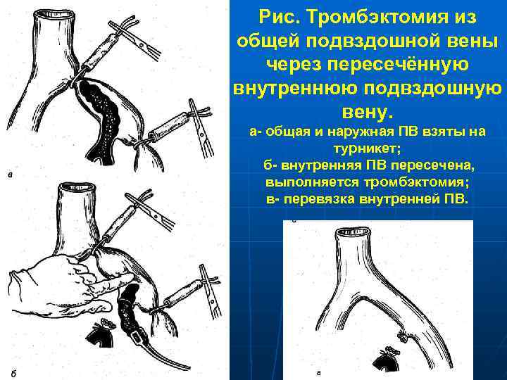 Рис. Тромбэктомия из общей подвздошной вены через пересечённую внутреннюю подвздошную вену. а- общая и