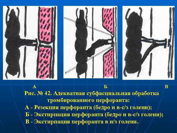 А Б Рис. № 42. Адекватная субфасциальная обработка тромбированного перфоранта: А - Резекция перфоранта