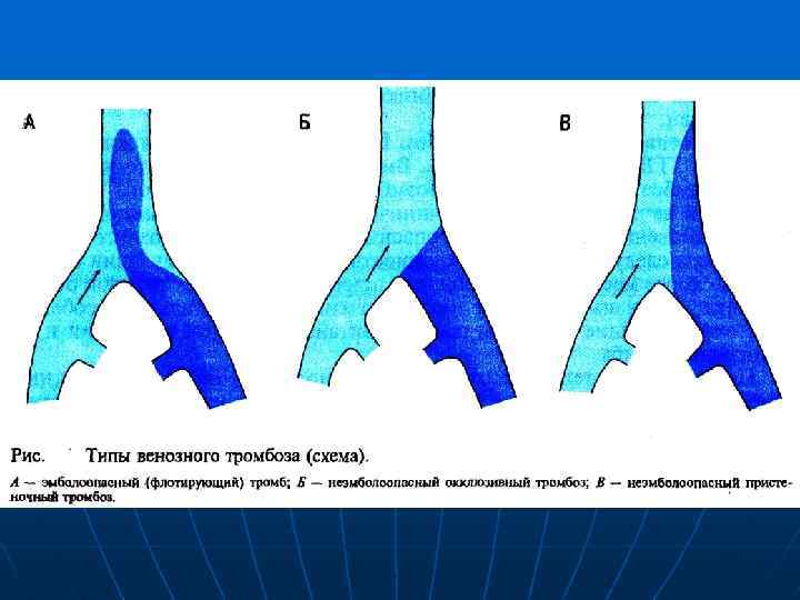 Типы тромбозов. Флотирующий тромб классификация. Виды тромбов флотирующий.