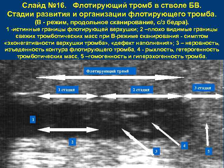 Слайд № 16. Флотирующий тромб в стволе БВ. Стадии развития и организации флотирующего тромба.