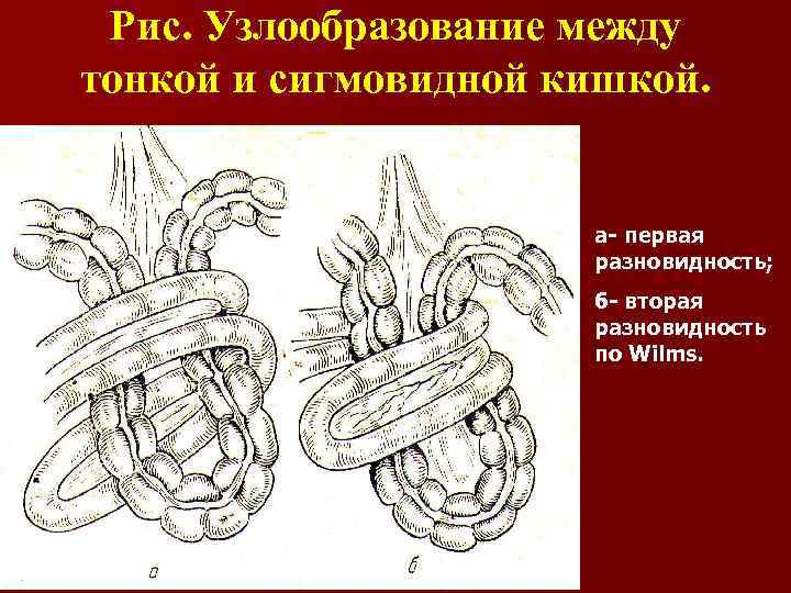 Рис. Узлообразование между тонкой и сигмовидной кишкой. а- первая разновидность; б- вторая разновидность по