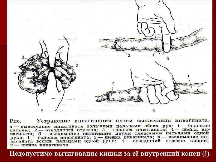 Недопустимо вытягивание кишки за её внутренний конец (!). 