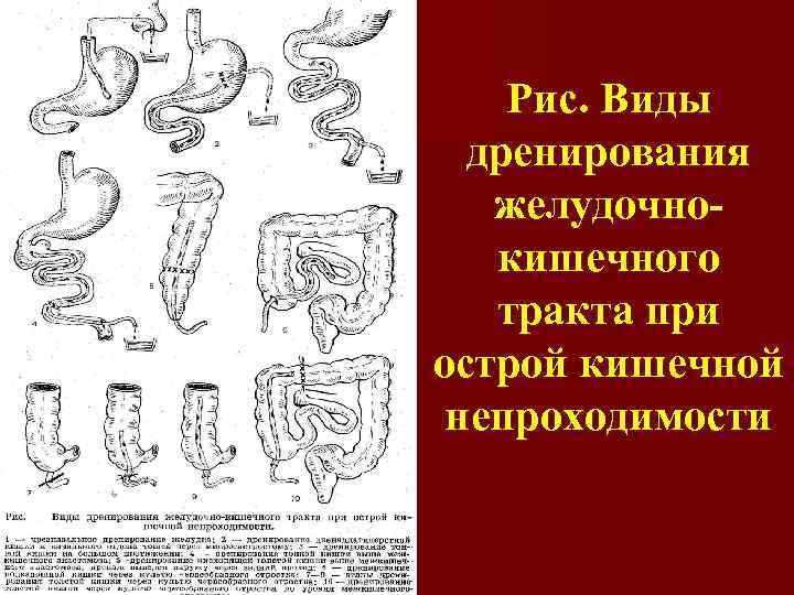 Рис. Виды дренирования желудочнокишечного тракта при острой кишечной непроходимости 