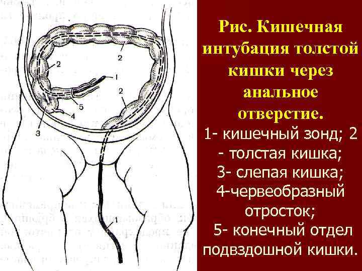 Рис. Кишечная интубация толстой кишки через анальное отверстие. 1 - кишечный зонд; 2 -