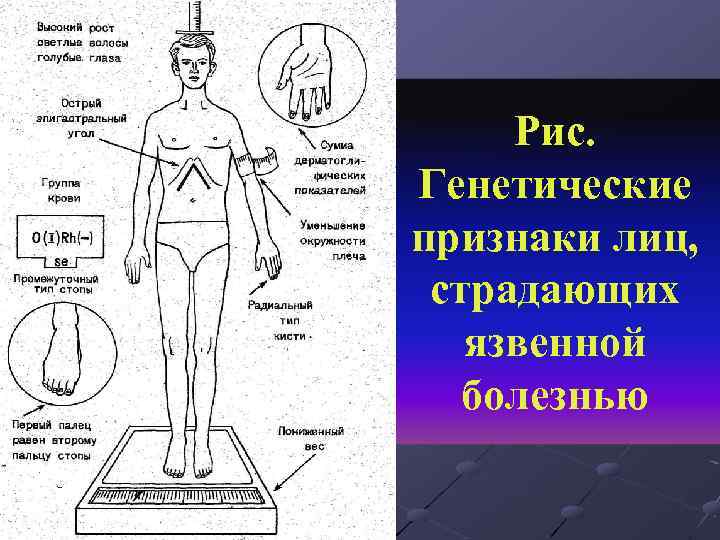 Рис. Генетические признаки лиц, страдающих язвенной болезнью 