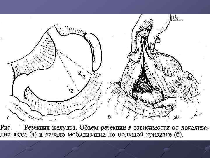 Размер желудка. Объём желудка взрослого человека. Нормальный объем желудка. Емкость желудка. Нормальная вместимость желудка.