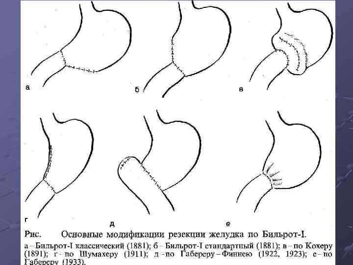 Язва малой кривизны желудка схема