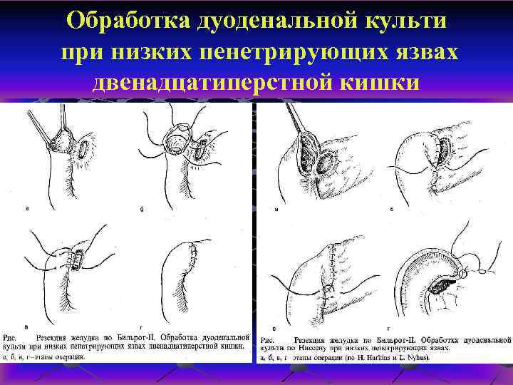 Обработка дуоденальной культи при низких пенетрирующих язвах двенадцатиперстной кишки 