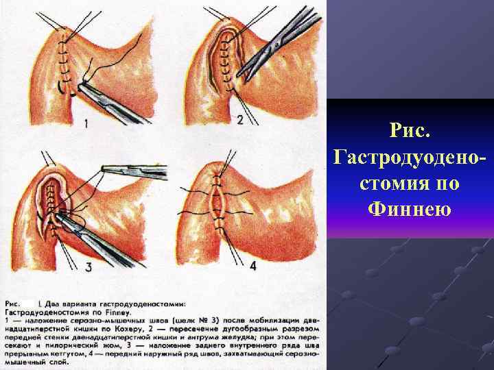 Рис. Гастродуоденостомия по Финнею 