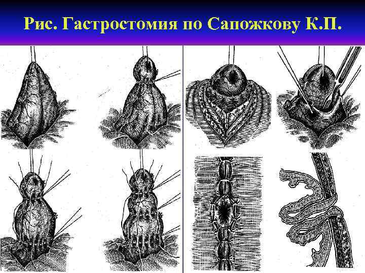 Рис. Гастростомия по Сапожкову К. П. 