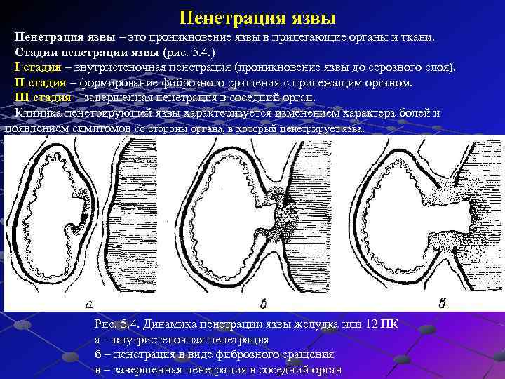 Пенитрация или пенетрация что это