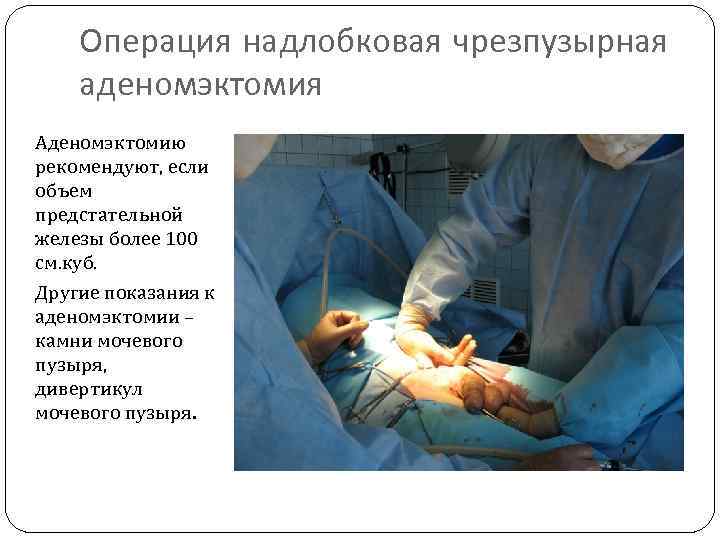 Операция надлобковая чрезпузырная аденомэктомия Аденомэктомию рекомендуют, если объем предстательной железы более 100 см. куб.