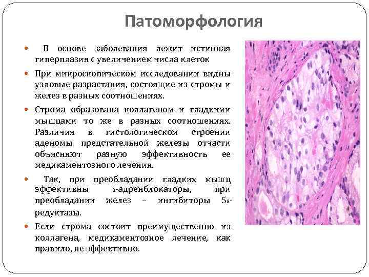 40 гиперплазия предстательной железы. Доброкачественная гиперплазия предстательной железы патанатомия. Железистая гипертрофия предстательной железы микропрепарат. Гиперплазия предстательной железы патологическая анатомия. Предстательная железа микропрепарат.