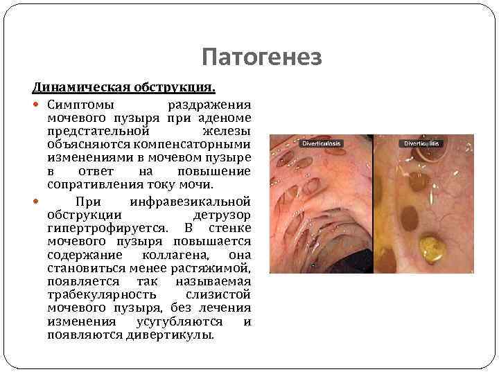 Патогенез Динамическая обструкция. Симптомы раздражения мочевого пузыря при аденоме предстательной железы объясняются компенсаторными изменениями