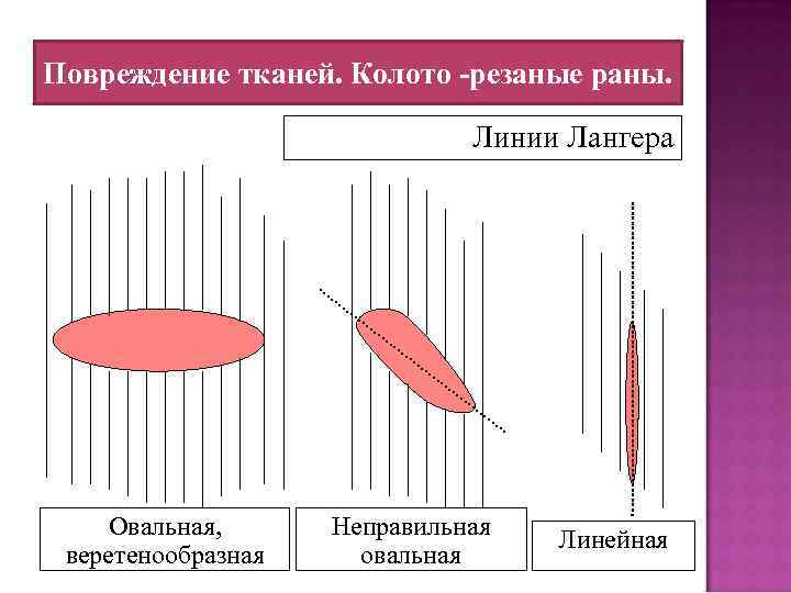 Повреждение тканей. Колото -резаные раны. Линии Лангера Овальная, веретенообразная Неправильная овальная Линейная 