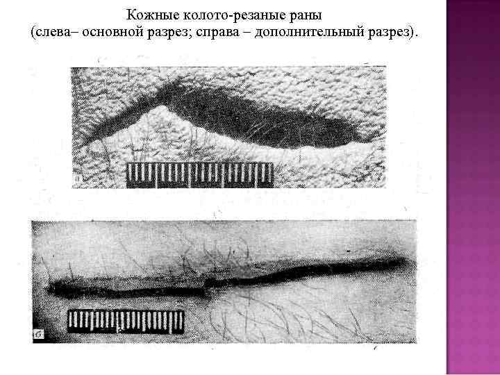 Кожные колото-резаные раны (слева– основной разрез; справа – дополнительный разрез). 