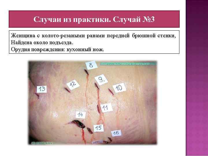 Случаи из практики. Случай № 3 Женщина с колото-резаными ранами передней брюшной стенки, Найдена