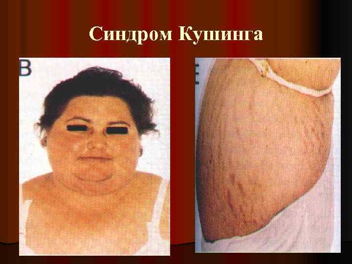 Синдром Кушинга 