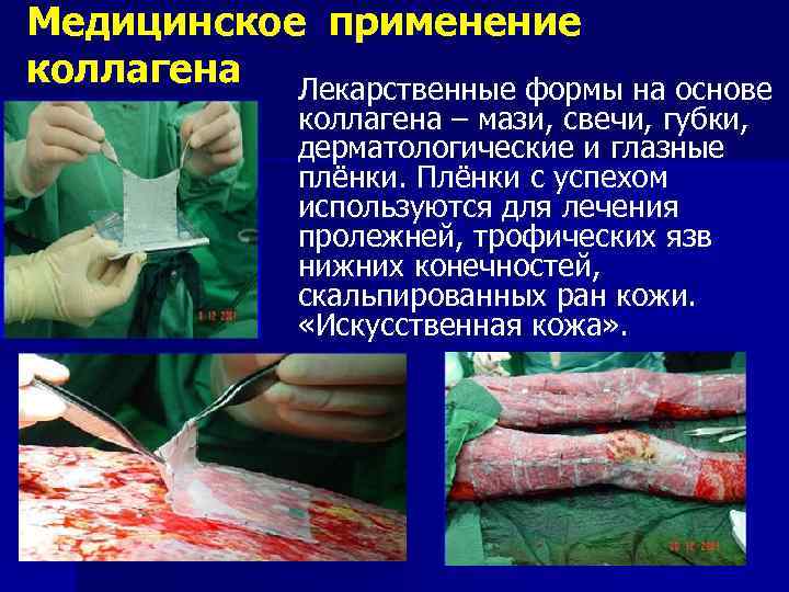 Медицинское применение коллагена Лекарственные формы на основе коллагена – мази, свечи, губки, дерматологические и