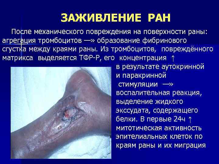 ЗАЖИВЛЕНИЕ РАН После механического повреждения на поверхности раны: агрегация тромбоцитов —» образование фибринового сгустка