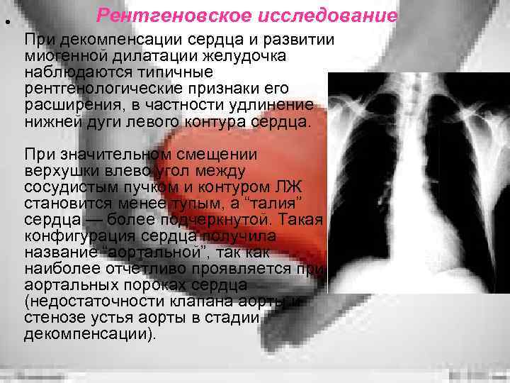  • Рентгеновское исследование При декомпенсации сердца и развитии миогенной дилатации желудочка наблюдаются типичные