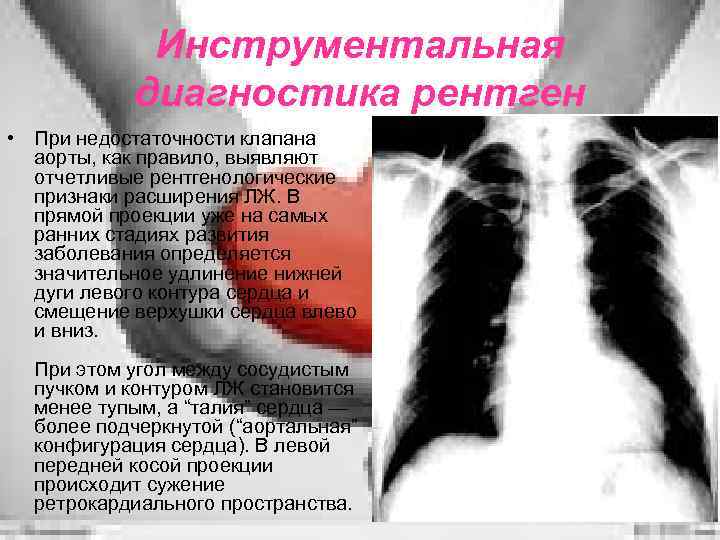 Инструментальная диагностика рентген • При недостаточности клапана аорты, как правило, выявляют отчетливые рентгенологические признаки