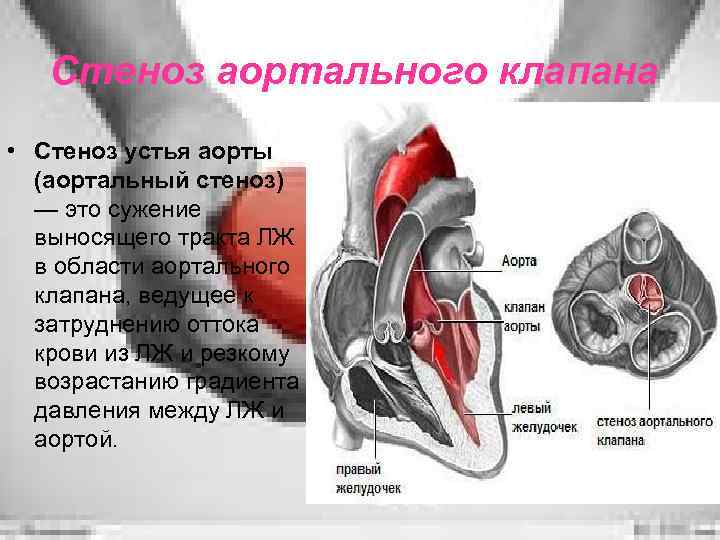 Стеноз аортального клапана • Стеноз устья аорты (аортальный стеноз) — это сужение выносящего тракта
