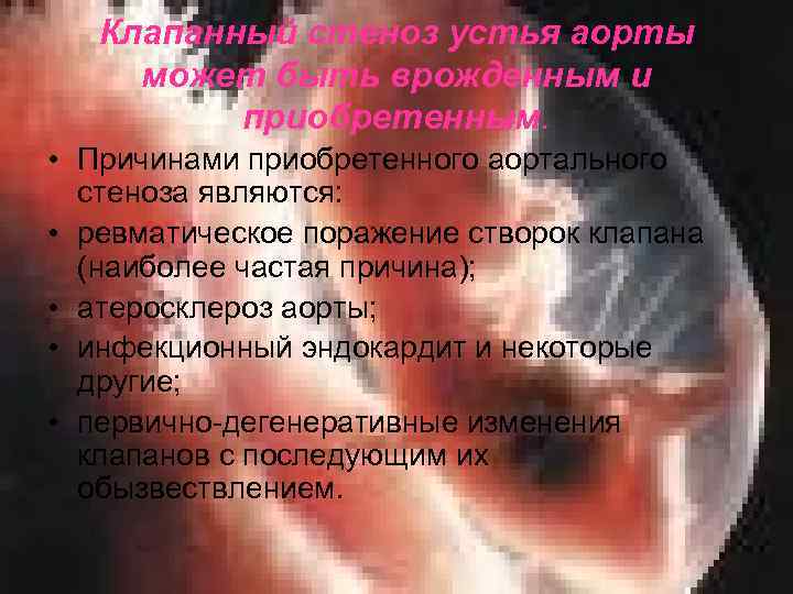 Клапанный стеноз устья аорты может быть врожденным и приобретенным. • Причинами приобретенного аортального стеноза