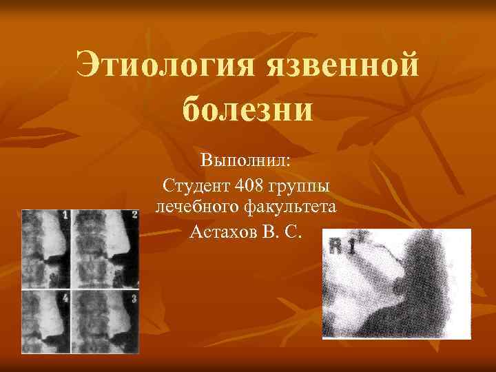 Этиология язвенной болезни Выполнил: Студент 408 группы лечебного факультета Астахов В. С. 