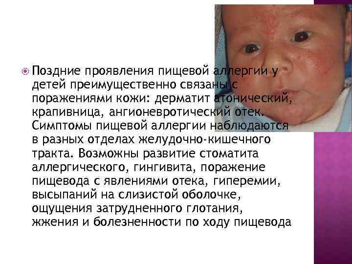  Поздние проявления пищевой аллергии у детей преимущественно связаны с поражениями кожи: дерматит атонический,