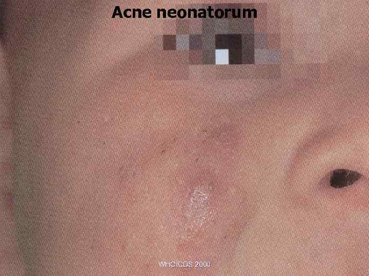 Acne neonatorum WHO/CDS 2000 
